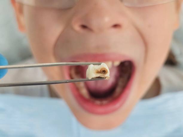 Best Emergency Treatment for Dental Infections or Abscesses in Fostoria, OH