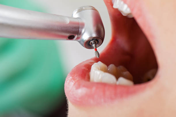 Best Emergency Treatment for Dental Infections or Abscesses in Fostoria, OH